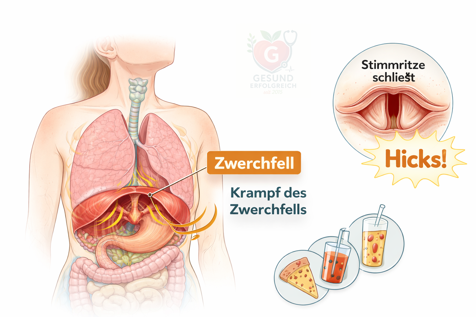 Schluckauf entsteht durch einen Reflex des Zwerchfells und das kurze Schließen der Stimmritze